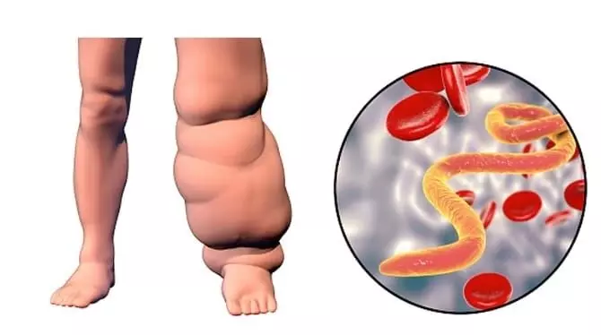 भारत में लिम्फैटिक फाइलेरियासिस पर जलवायु परिवर्तन का खतरनाक प्रभाव