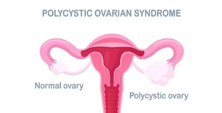 अब अपने पीसीओडी पर रखें नियंत्रण,आज़माएं इन आदतों को